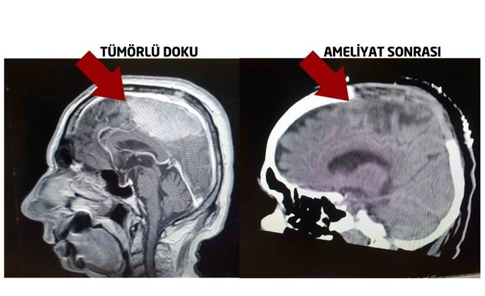 Alman doktorların felç ettiği hastayı Türk doktorlar ayağa kaldırdı