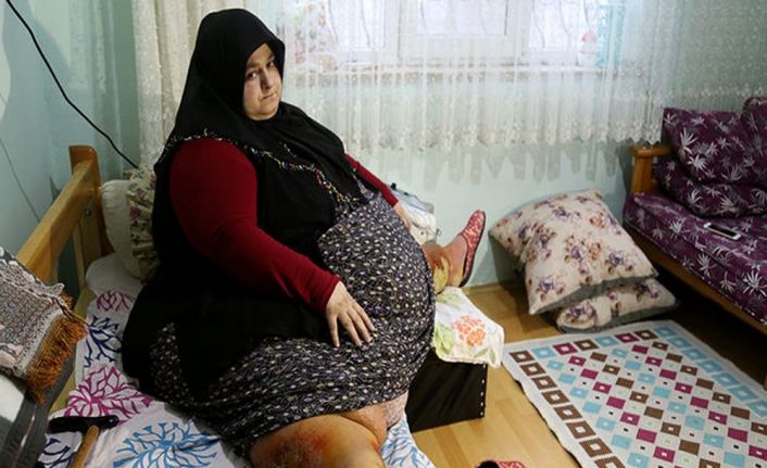 Sakarya’da yaşayan ve 250 kilo olan Sevim Bal obezite ameliyatı ile 95 kiloya düştü