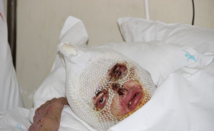 Tüp patlaması sonucu yanan kadın 2 aydır iyileşeceği günü bekliyor