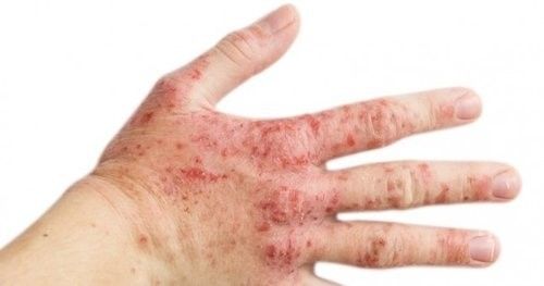 Sizde de bu belirtiler varsa, Rozasea olabilirsiniz