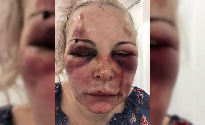 Otel odasında günlerce darp edilen Rus kadın konuştu: “Yaşamla ölüm arasındaydım”