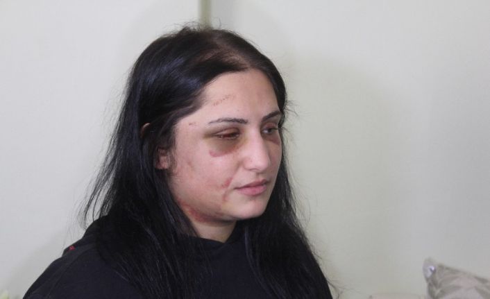 Samsun’da eski eşinin darp ettiği kadın konuştu: “En ağır şekilde cezalandırılmasını istiyorum”