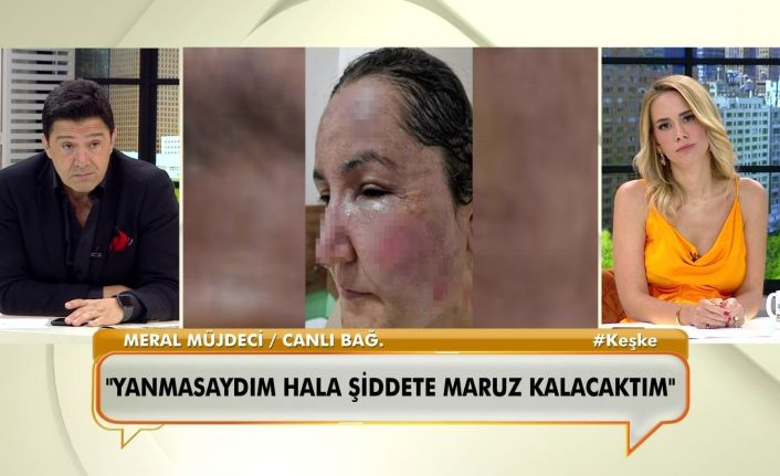 Canlı yayında bağlanan kadın, eşinin kendisini kızgın yağ ile yaktığını söyledi