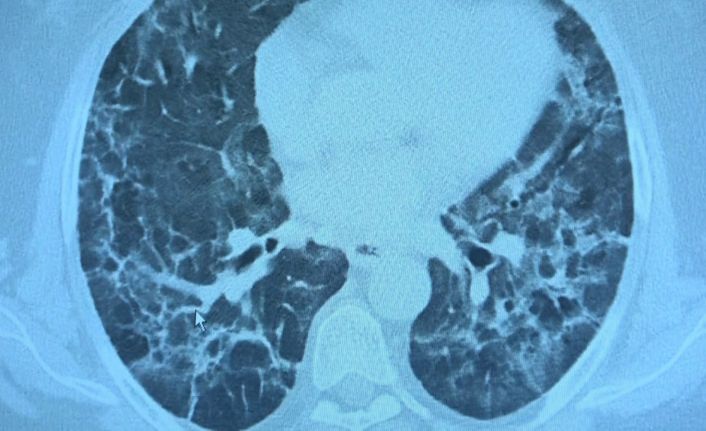 Korona virüs geçiren hastalarda yeni klinik bulgular: "Uzamış Covid ve post Covid"