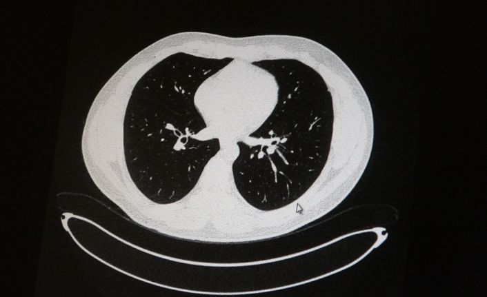 Aşılı ve aşısız olarak koronaya yakalanan 2 gencin akciğer tomografisi korkunç gerçeği gözler önüne serdi