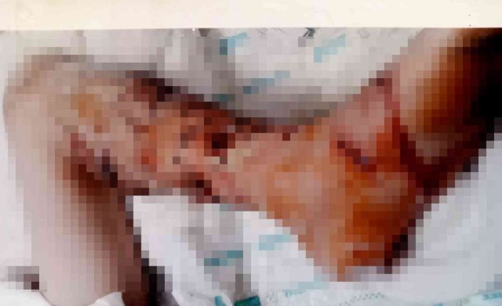 4 yıl önce pitbull saldırısına uğrayan çocuk, psikolojik tedavi alıyor