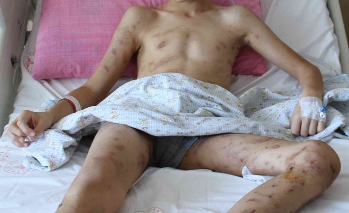 (ÖZEL) 10 köpeğin saldırısına uğrayan 12 yaşındaki Enes, 9 cerrahi operasyon geçirdi, 6-7 tane daha geçirmesi planlanıyor