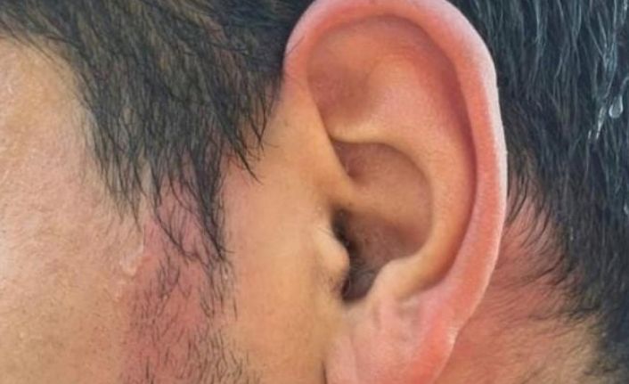 Ümraniye’de İETT otobüsünün klima borusu patladı, bir yolcunun yüzü yandı