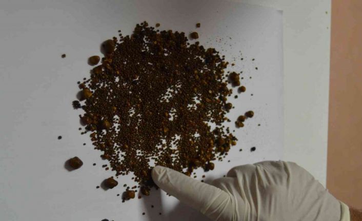 Safra kesesi değil sanki taş ocağı: 4 bin 536 taş çıktı