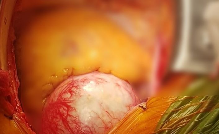 Aort damarı 3 kat büyüyen hasta ölümden döndü