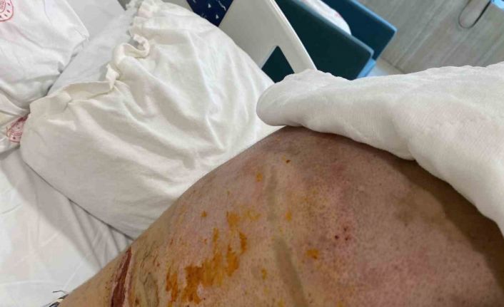 Beyoğlu’nda barda yanan genç kız dehşet anlarını anlattı: "Bir anda alev topuna döndüm"