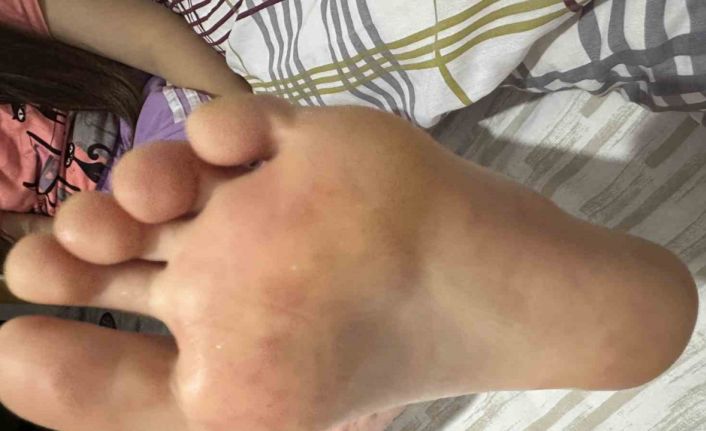 Çocuklarda artan el ayak ağız hastalığına dikkat: Uzmanlar tatilde ortak kullanılan alanlara karşı uyardı