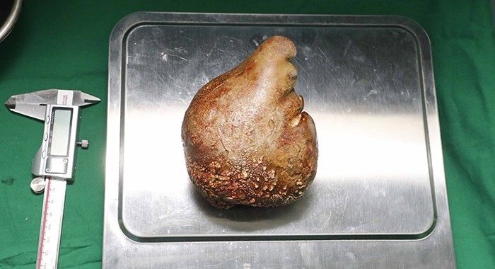 Sri Lanka’da dünya rekoru: 801 gram ağırlığında böbrek taşı çıkarıldı