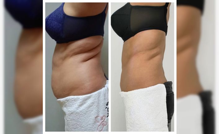 Tek seansta 3.5 santim incelme mümkün