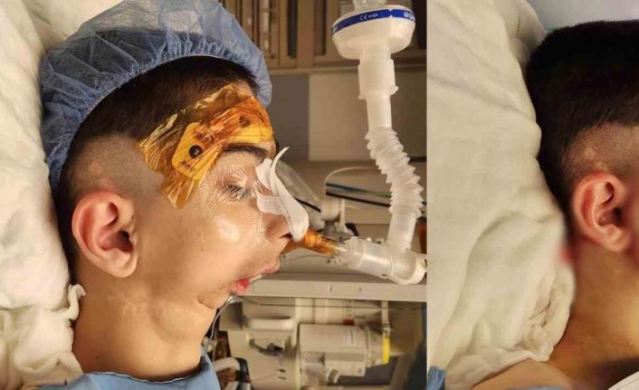 Doğuştan alt çenesi olmayan çocuğa başarılı operasyon: 17 yıl sonra normal yemek yiyebilecek