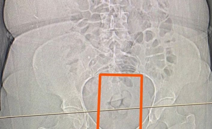 Midesinden 21,39 gram uyuşturucu çıktı