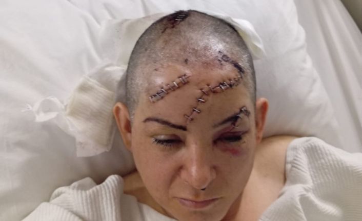 Nevşehir’de eşinin satırla ağır yaraladığı kadın yaşadığı dehşeti anlattı