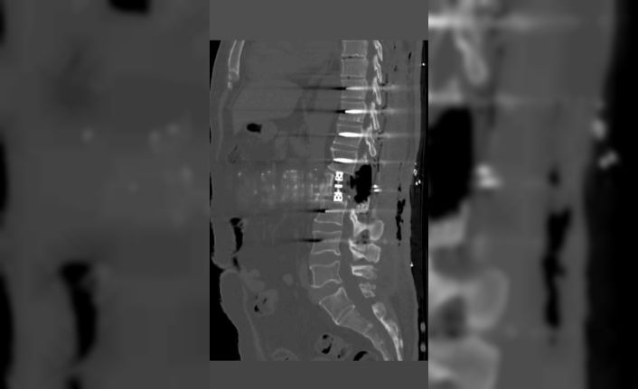 Bayburt’ta omur gövdesi çıkarılarak yapılan ameliyat başarıyla gerçekleşti