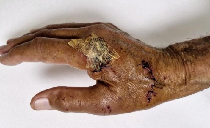 Duşakabin patladı, eline 20’ye yakın dikiş atıldı