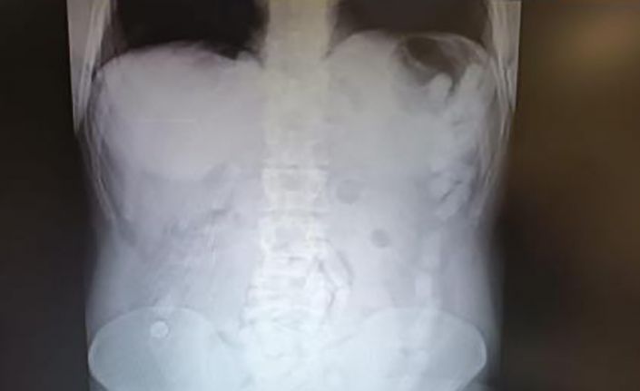 Midesinde uyuşturucu maddeyle yakalanan şahsa 12 yıl hapis cezası