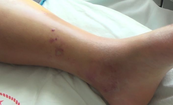 Tunceli’de koca engerek yılanının ısırdığı kadın, tedavi altına alındı