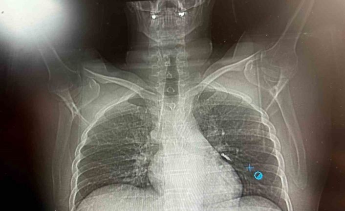 İmplant vidası ciğerine kaçan hasta ölümden döndü