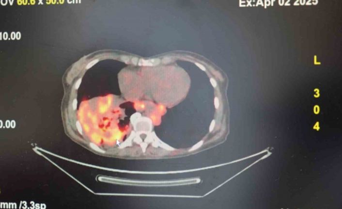 ’Sigarasız akciğer kanseri’ vakalarında dikkat çeken artış