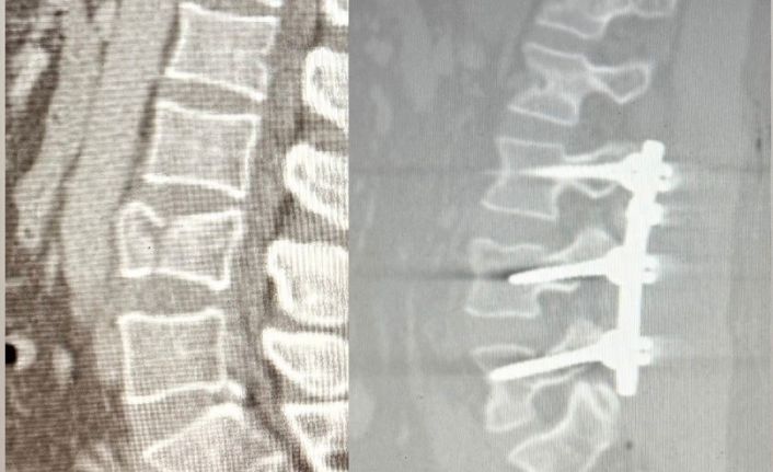 Yüksekten düşen hasta, Patnos’ta ilk kez uygulanan ameliyatla ayağa kalktı