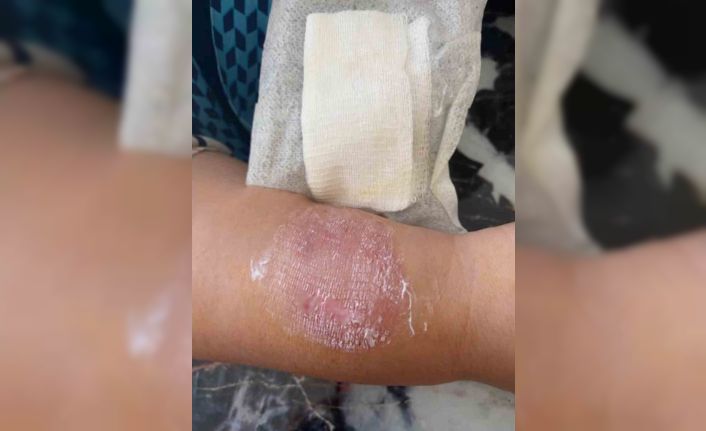 Büyükçekmece’de sigara dumanı tartışmasında kolunu ısırdı