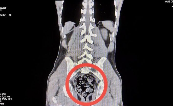 Kars’ta İranlı kuryenin makatından uyuşturucu çıktı