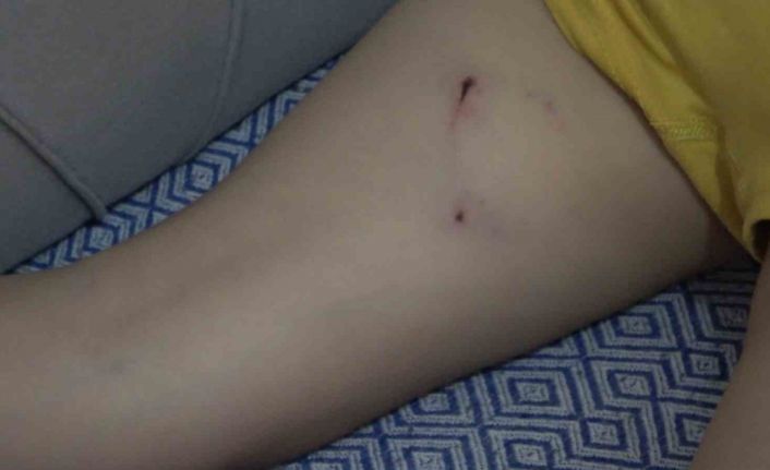 Rize’de 5 yaşındaki çocuk, sokak köpeğinin saldırısına uğradı