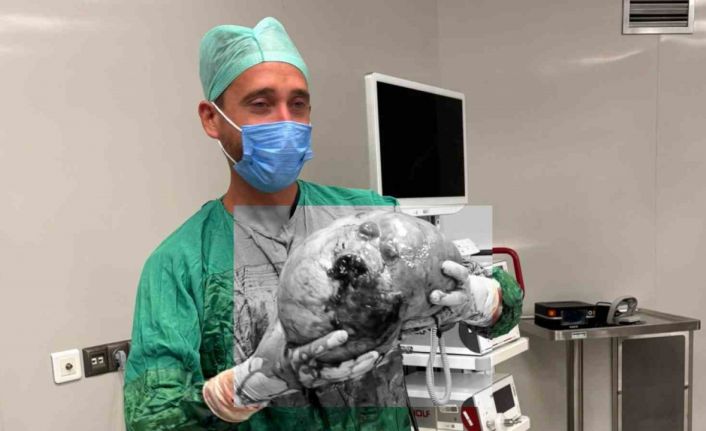 Yozgat’ta bir hastadan karpuz büyüklüğünde kitle çıkartıldı