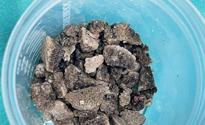 8 santimetrelik ’geyik boynuzu’ böbrek taşı kapalı yöntemle çıkarıldı