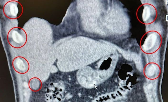 Midelerinden 136 kapsül uyuşturucu çıktı