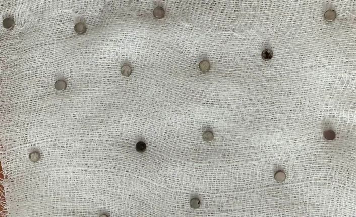 Çocuğun boğazından 19 adet mıknatıs çıkartıldı