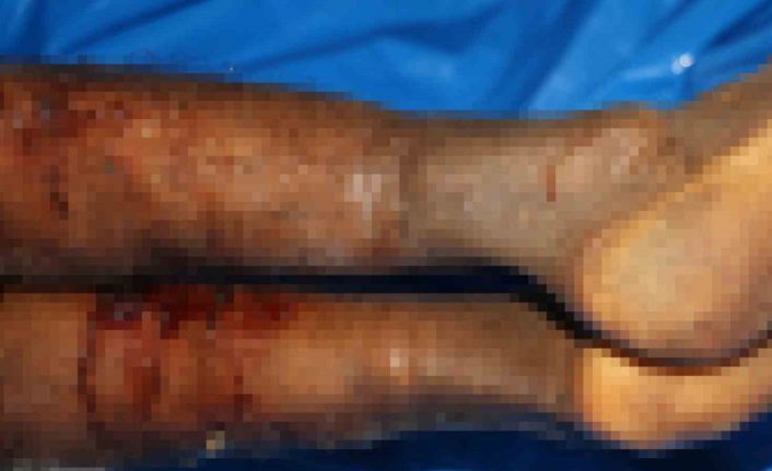 İsrail’in iade ettiği cenazelerde işkence izleri görüldü