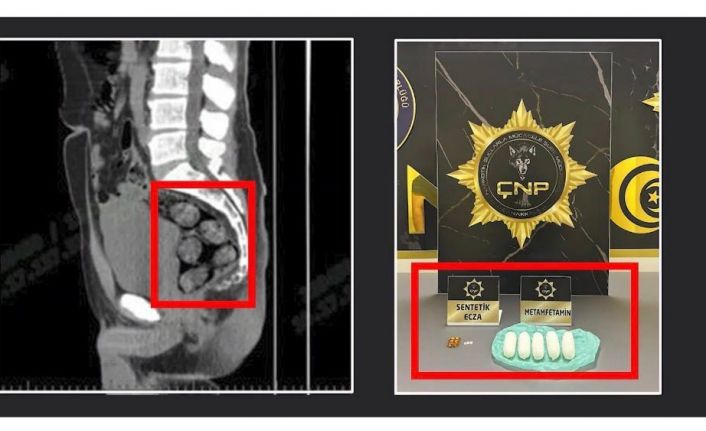 Tomografide şok eden görüntü...Uyuşturucu midesinden çıkarıldı