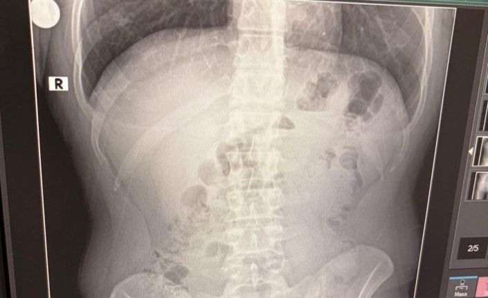 Uşak’ta midelerinden uyuşturucu çıktı: İranlı 3 kişi tutuklandı