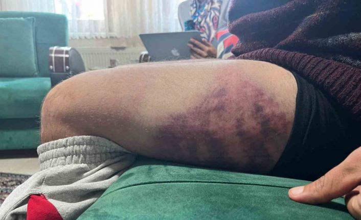 Vicdanları yaralayan olay: Otizmli şahıs odunluğa baktı diye odunla darbedildi