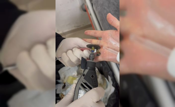 Batman’da parmağa sıkışan iki yüzük ’spiral makine’ ile çıkarıldı