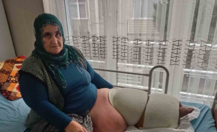 Fil hastalığı bacağını 100 kilo yaptı, tedavisinin devamı için destek bekliyor