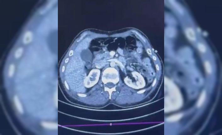 Ülkeye midelerinde uyuşturucu getiren şahıslar yakalandı