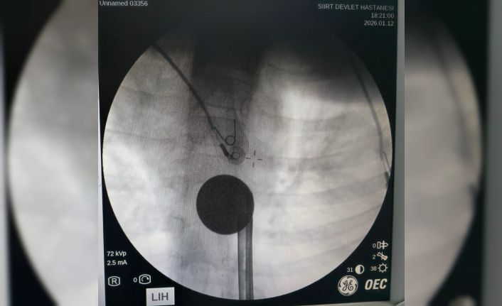 Siirt’te boğazına madeni para kaçan çocuk, doktorların müdahalesi ile kurtarıldı