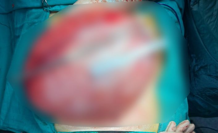 Kilo vermek için hastaneye giden çocuğun karnından 3,5 kiloluk kist çıktı