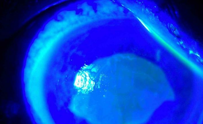 ’Kırlangıç otu kullanımı’na dikkat, uzmanlar uyarıyor: "Gözlerine suyunu damlattı, göremez hale geldi"