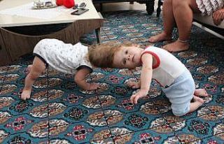 Kafadan yapışık siyam ikizleri 1 yaşında