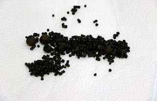 Yaşlı kadının safra kesesinden 450 tane taş çıktı