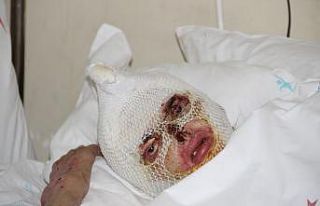 Tüp patlaması sonucu yanan kadın 2 aydır iyileşeceği...