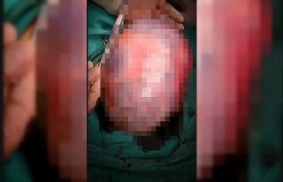 Genç kadının karnındaki 30 santimetrelik kist...