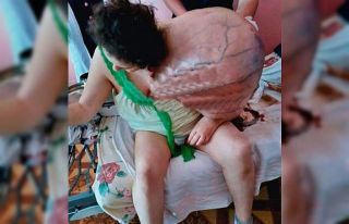 Hasta kadın omzundaki devasa tümörü taşıyamaz...